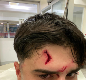 Scopri di più sull'articolo RIMINI: AGGRESSIONE VIOLENTA CON LANCI DI BOTTIGLIE E SEDIE DI NOTTE GIOVANE FERITO